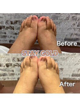 ステイゴールド 新百合ヶ丘(STAY GOLD)/足脱毛とセットで甲と指も脱毛!