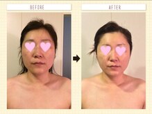 ハピア(HappiA)/小顔コルギ　5回の効果