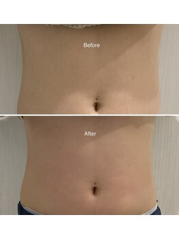 セラス(CERAS)/フォースカッター　お腹30分