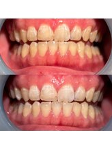 モゼ(moze)/美白ホワイトニング