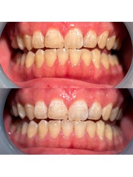 モゼ(moze)/美白ホワイトニング