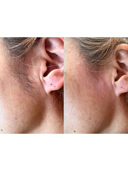 顔脱毛がしたい