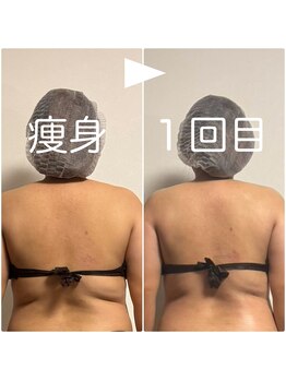 太陽と月/全身痩身♪1回でも変化~♪