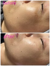 アスピリア(aspirer a')/石膏パックで横顔美人へ‥