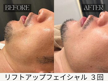 スキンジム(SKIN GYM)/フェイスラインすっきり=若見え