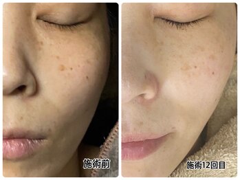 リアン/本気で変わりたい方の肌質改善。