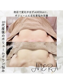 アネラ(ANERA) 心斎橋/産後ママボリュームアップ成功!