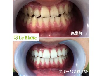 ルブラン 奈良店(Le Blanc)/歯の黄ばみ解決！