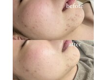 サーデ(saade)/なくなりにくい部分荒れにも◯