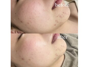 サーデ(saade)/なくなりにくい部分荒れにも◯