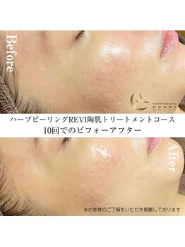 エスプリ 銀座店/ハーブピーリング銀座