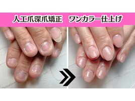 ウエディング深爪矯正