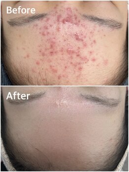 スハダビ110(suhadabi110)/before after