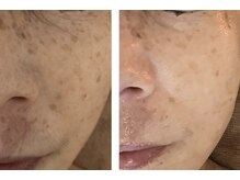 エステ2回　石鹸、美容液、お化粧水使用