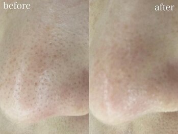 ホワイトアクア 池袋店(WHITE AQUA)/ハーブピーリング/毛穴洗浄/池袋