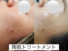 ルーク(Luke)の雰囲気（繰り返すニキビに、本気の肌改善ケア☆陶器のような肌へ。）