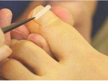 東京巻き爪センター 本院 麻布十番/巻き爪矯正【東京/巻き爪】