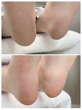 リンネ(Rinne)/角質ケア