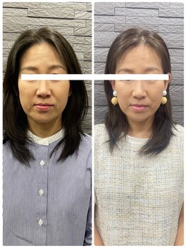 長寿鍼灸院 長寿整骨院/ハリネズミ女優美容鍼効果★