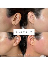 ホテルアンドパーク(HOTEL&PARK.)/もみあげワックス脱毛Mizuki施術