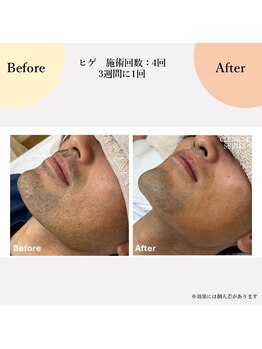 スリール(sourire)/ヒゲ脱毛