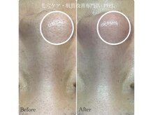 ピエル 北千住店(PIEL)/見違えるお鼻に