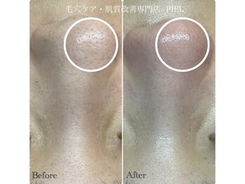 ピエル 北千住店(PIEL)/見違えるお鼻に