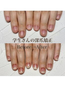 高校生の深爪矯正