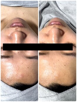 ナチュールムーン(Nature moon.)/毛穴洗浄・ハーブピーリング