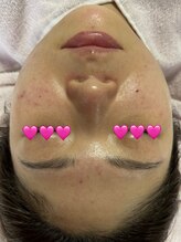 リアスキン(Lia skin)/ニキビ、赤みでお悩みの方