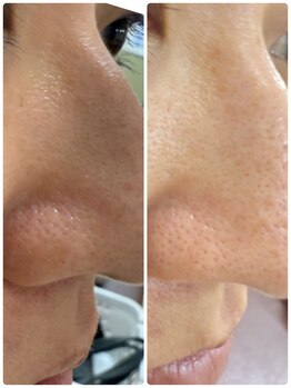 エミタス整骨院/1度の毛穴洗浄でここまで変わる