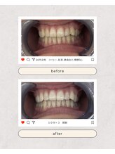スマイルプライベートビューティサロン(Smile)/セルフホワイトニング