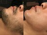 【何回でも同価格】顔WAX脱毛3パーツ(おでこ、鼻、鼻下)