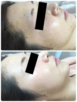 メイユール(MEILLEUR)/光フェイシャル6回