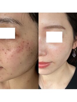 美バストアルファ(美bust α)/【シミケア】お客様の声