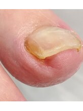 001 新横浜/刺さっていた部分も一回で改善