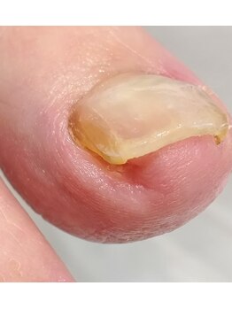 001 新横浜/刺さっていた部分も一回で改善