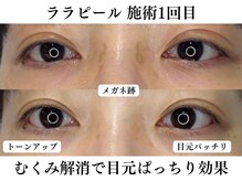 ブレリアントサロン 池袋店(brillant salon)/【30代】ララピール(施術1回目)