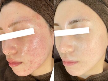 ビスキン(BeSkin)/剥離なしReviハーブピーリング