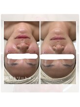 アチェリー(aCherry)/陶肌トリートメント