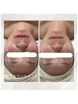 アチェリー(aCherry)/陶肌トリートメント