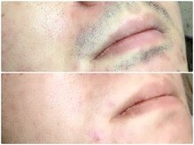 カルム(Calme)/ヒゲ脱毛　２０代