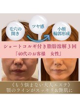 アンシャンテ(Anchant)/【半永久的に脂肪分解】