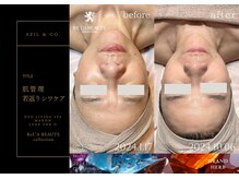 オーヴォ リビングスパ アネックス マノン(OVO LIVING SPA annex MANON)/【施術事例】定期肌管理