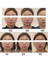 エイジェイビューティー 上野店(AJ Beauty)/小顔コルギの変化♪