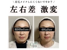キュープ 浜松店(Qpu)の雰囲気（小顔効果だけなく顔の左右バランスも均等に。顔質が変わります。）
