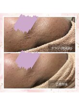 プリズミント(Prismint)/ニキビケア