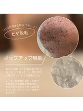 ファイブポイント(FIVE POINT)/ポロポロ抜ける、爆抜け髭脱毛