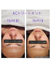 ハナ(HANA)/ACトリートメント1回の結果