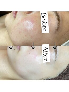 リノア(Linoa)/REVI陶肌トリートメント症例